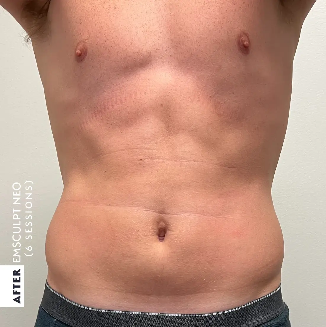 The same patient's abdomen, same position and lighting, after six EMSCULPT NEO sessions