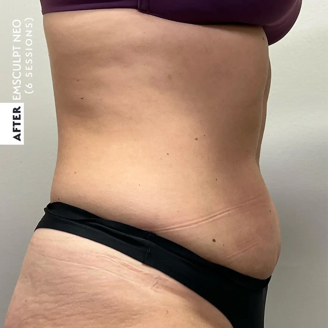 The same patient's abdomen from the side after six EMSCULPT NEO sessions