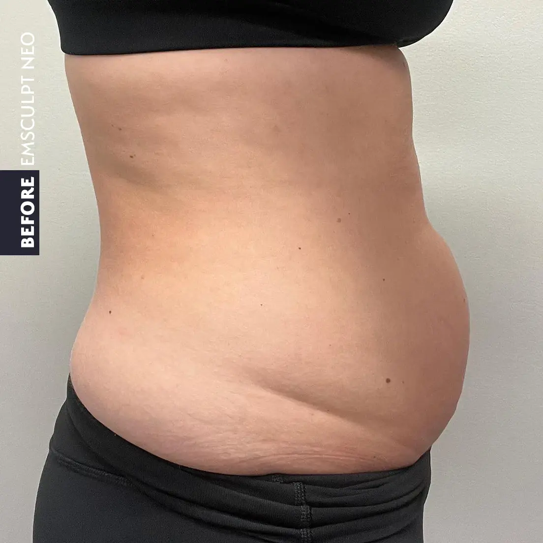 Side view of a patient's abdomen before EMSCULPT NEO treatment